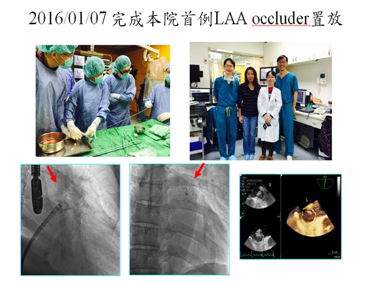 完成首例左心耳關閉術