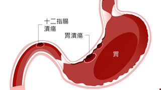 消化性潰瘍及出血