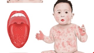 Kawasaki Disease 川崎氏症