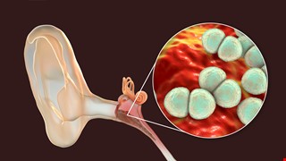 中耳炎