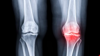 Osteoarthritis 認識退化性膝關節炎