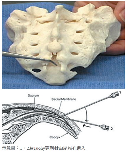 示意圖：1、2為Tuohy穿刺針由尾椎孔進入