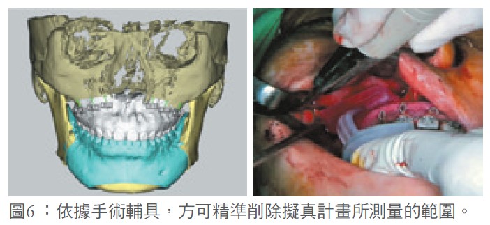 圖6 ：依據手術輔具，方可精準削除擬真計畫所測量的範圍。
