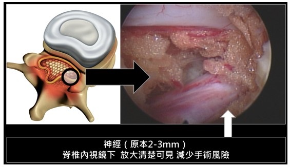 微創脊椎手術新選擇：脊椎內視鏡手術演進和介紹