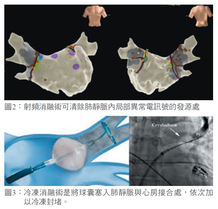 圖2：射頻消融術可清除肺靜脈內局部異常電訊號的發源處