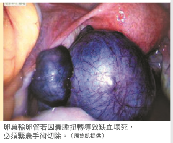 卵巢輸卵管若因囊腫扭轉導致缺血壞死，必須緊急手術切除。（周雋凱提供）