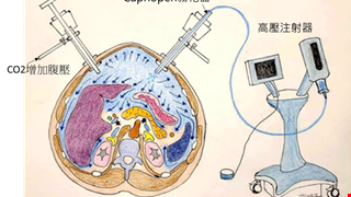 腹膜腫瘤治療新利器！腹腔高壓氣霧化學療法（PIPAC- Pressurized IntraPeritoneal Aerosol Chemotherapy）