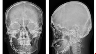 精準顱顏重建 —「電腦輔助設計3D列印」及「定位導航輔助」