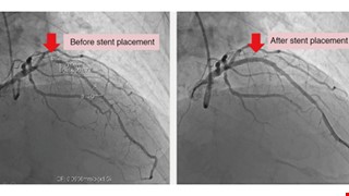 Innovating “Treadmill Exercise Test AI-Assisted Interpretation System,” CMUH(Taiwan) Timely Saves More Patients with Severe Myocardial Infarction